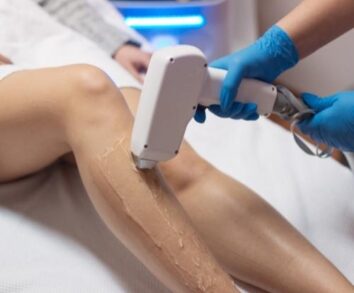 laser epilation london